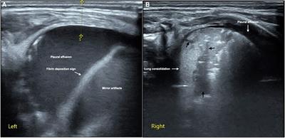 The specific signs of lung ultrasound to diagnose pulmonary hemorrhage of the newborns: Evidence from a multicenter retrospective case-control study